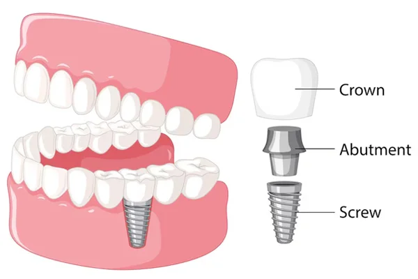 Dental Implants