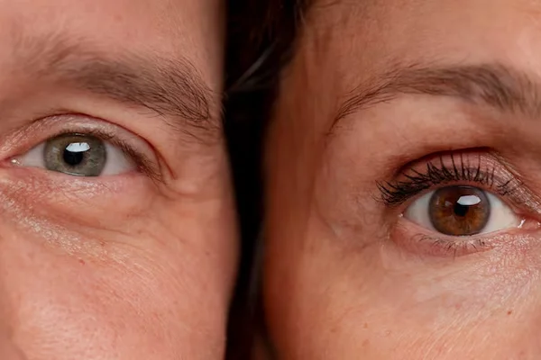 Both Upper Eyelid