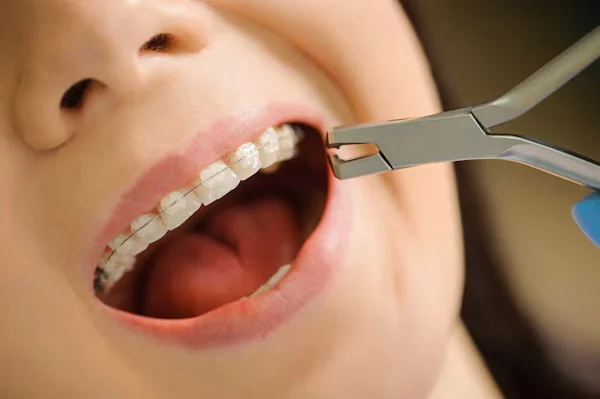 Ceramic Braces