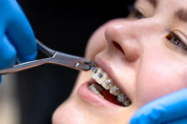 Self Ligating Braces