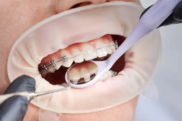 Fixed and Removable Retainers