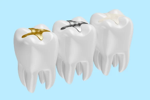 Glass Ionomer Fillings