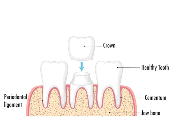 Dental Crowns