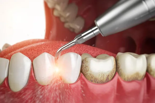 Dental Scaling and Plaque Removal