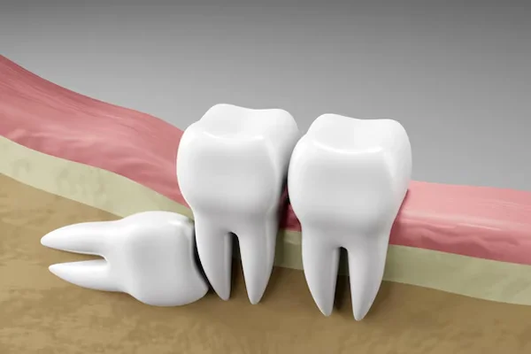 Wisdom Teeth Removal